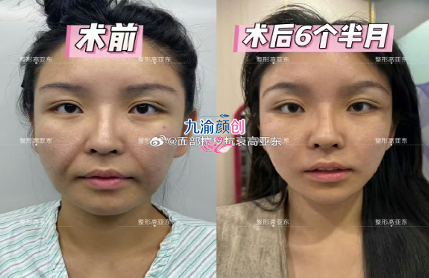 高亚东拉皮手术术后图片，医生个人资料介绍+案例价格表