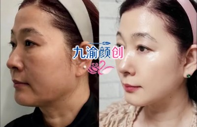 北京八大处刘暾小切口拉皮怎么样？手术费用/真人案例一览